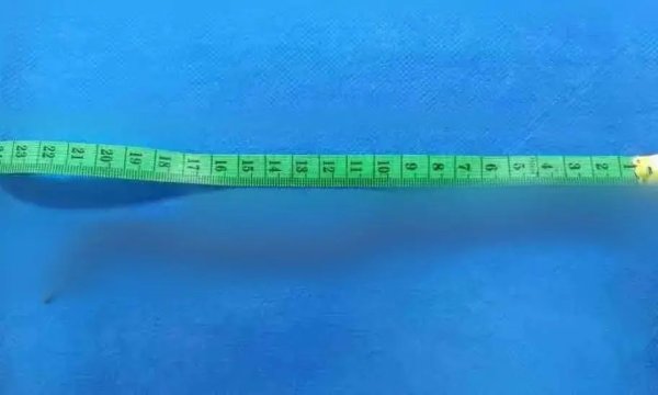 配资平台正规 紧急提醒！湖北58岁女子吃烤肉感染寄生虫，很多人也爱这么吃