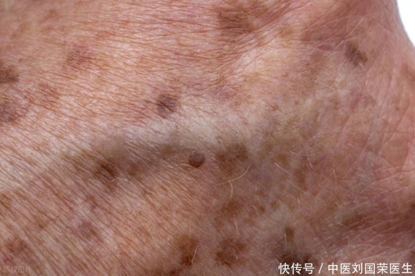 炒股配资入门知识网 手上和脸上长老年斑能去掉吗？为什么有人都70多岁了也没长斑